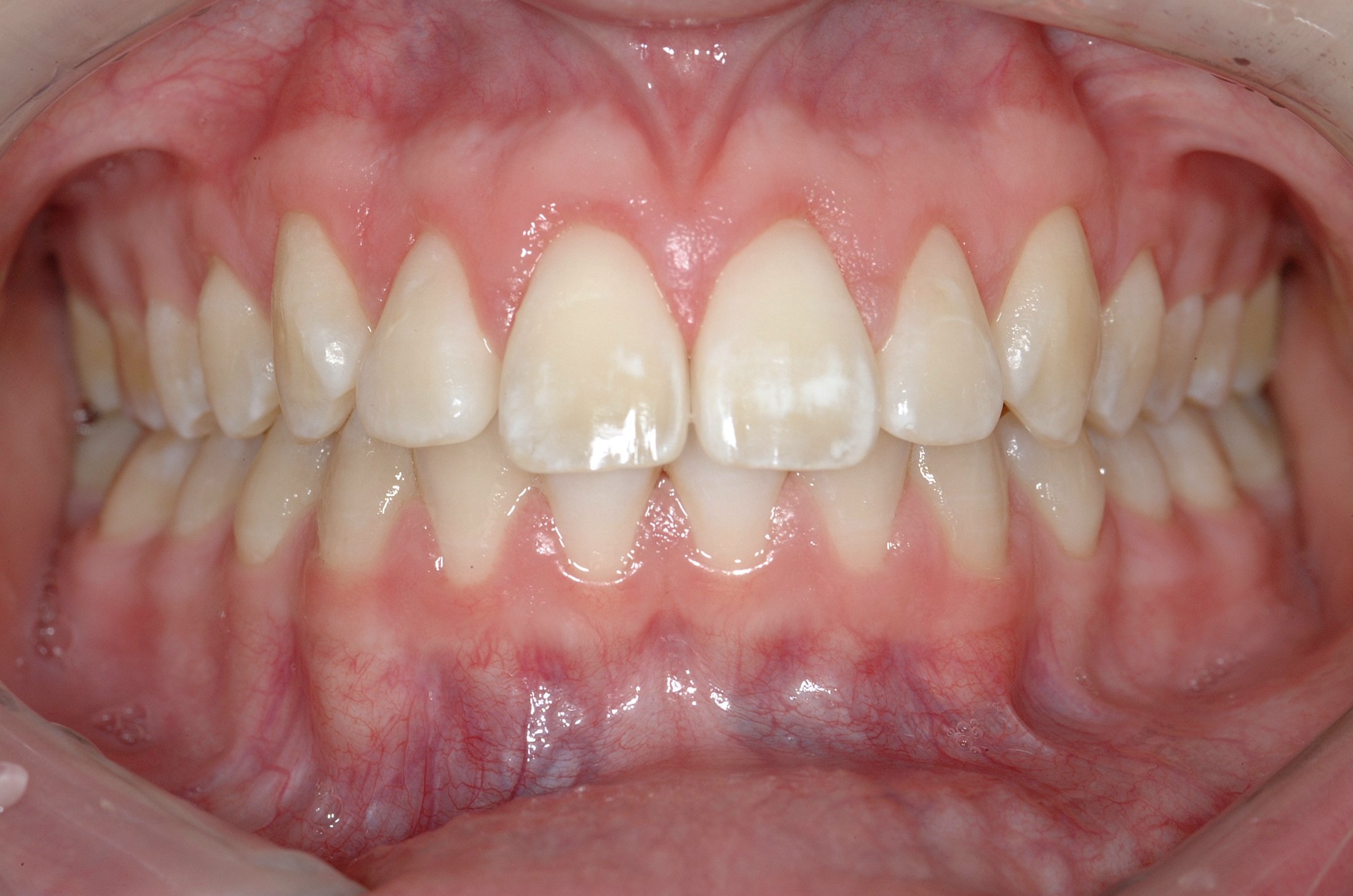 Esthetic Crown Lengthening Issaquah WA, Northwest Periodontics & Implants